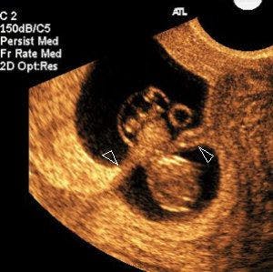 Recognizing Intra-amniotic Band-like Structures on Obstetric Ultrasound
