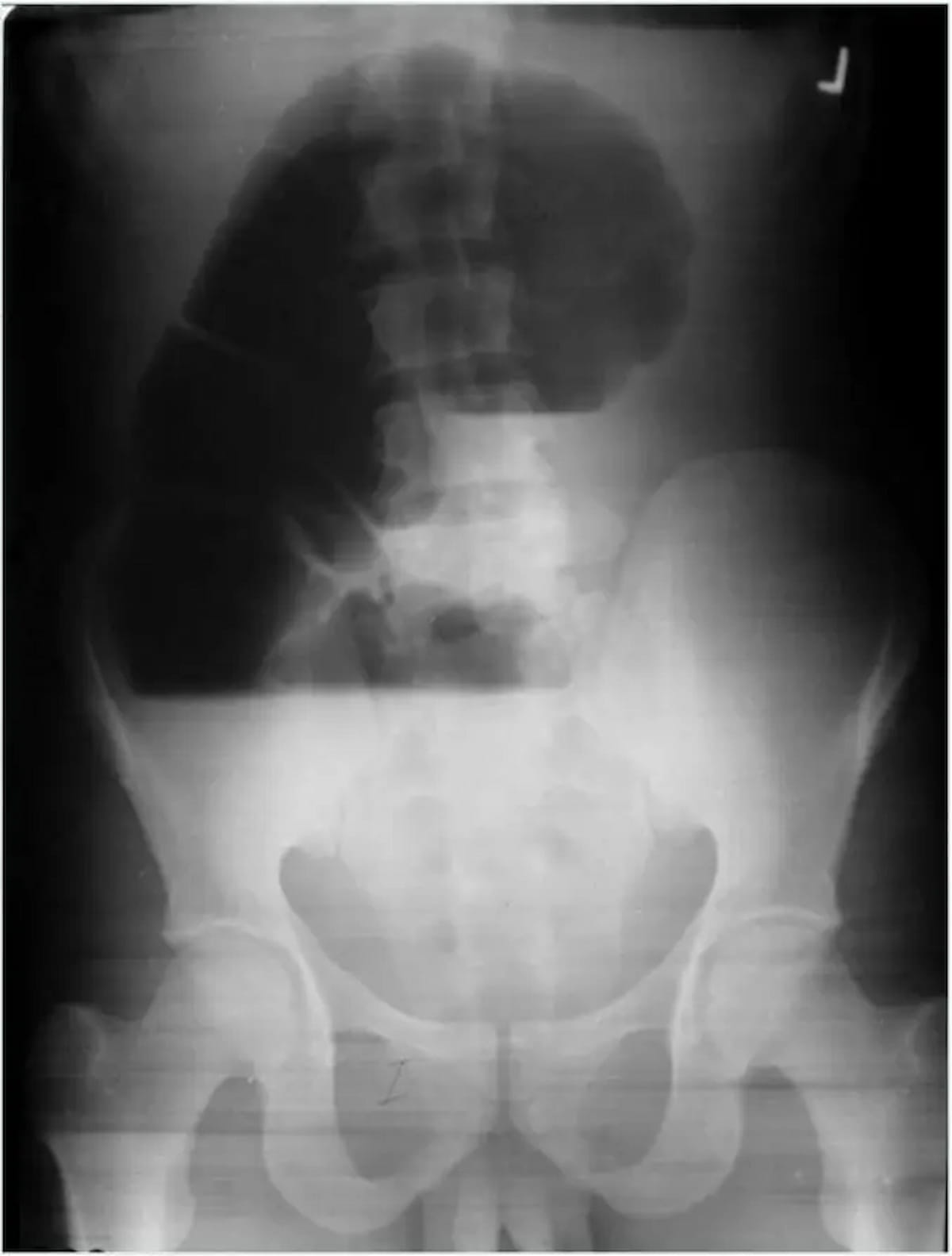 Image IQ Quiz: 40-Year-Old Patient with Abdominal Distension and Severe Abdominal Pain