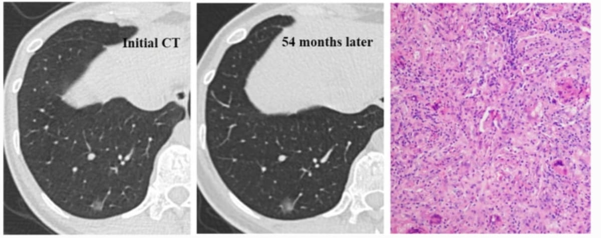 Current Insights on Differentiating Pulmonary Subsolid Nodules with Non-Contrast CT