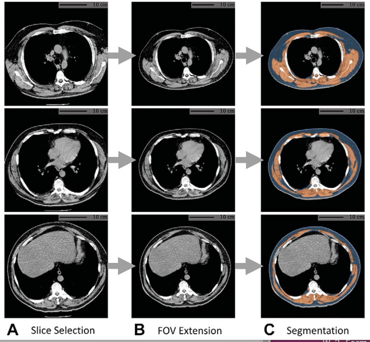 Study: AI Assessment of Chest CT May Predict Multiple Mortality Risks