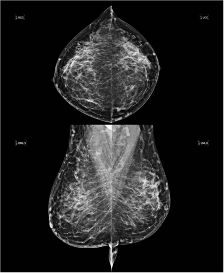Bilateral Breast Swelling due to Central Venous Occlusion