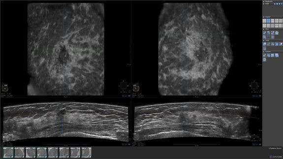 Using Automated Breast Ultrasound to Reduce or Eliminate Interval Cancers