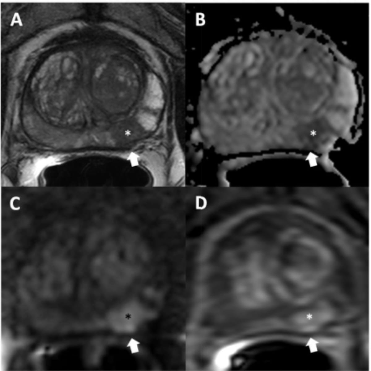 Can AI Improve Detection of Extraprostatic Extension on MRI?