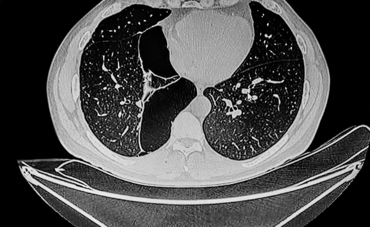 Study Finds Significant Incidental Findings in Nearly 34 Percent of Lung Screening CT Exams