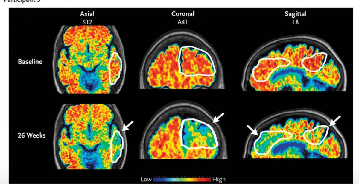 Could MRI-Guided Ultrasound Facilitate Improved Reduction of Amyloid-Beta Load in Patients with Alzheimer’s Disease?