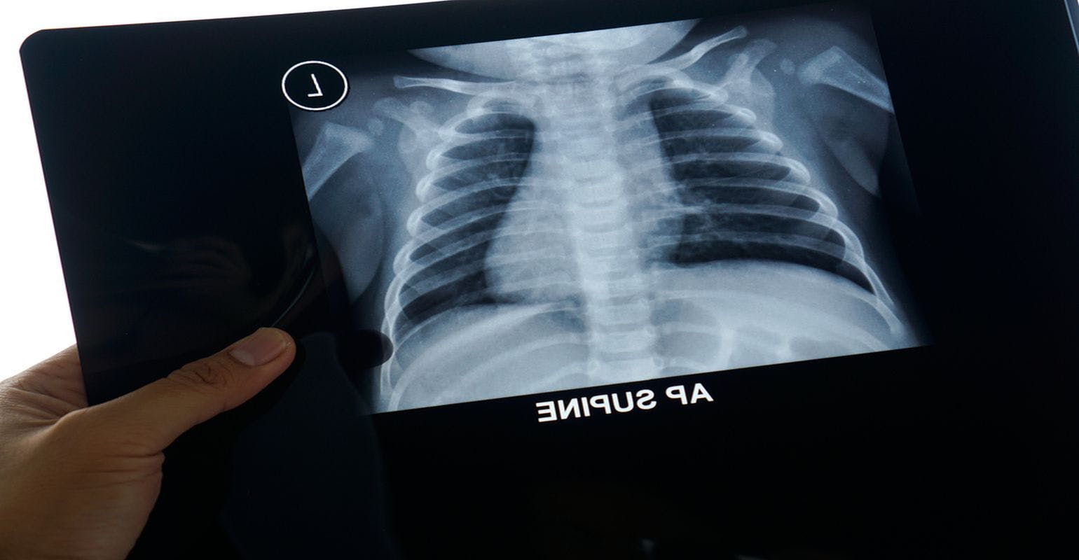 X-ray with Ultrasound Can Be Used to Manage Pneumonia in Children