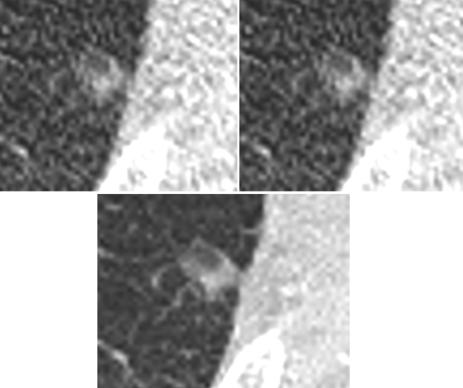 AI-Based Denoising Technique Achieves 76 Percent Reduction in Radiation Dosing for CT Lung Cancer Screening