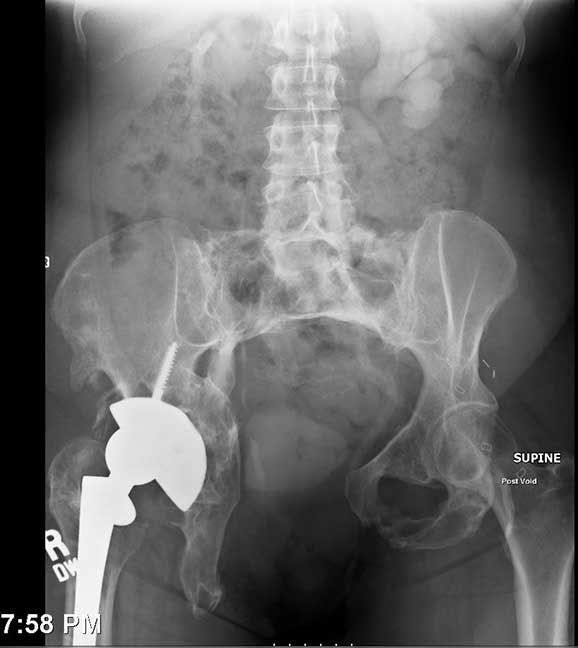 An Impressive Case of Procidentia with Concomitant Cystocele and Hydronephrosis