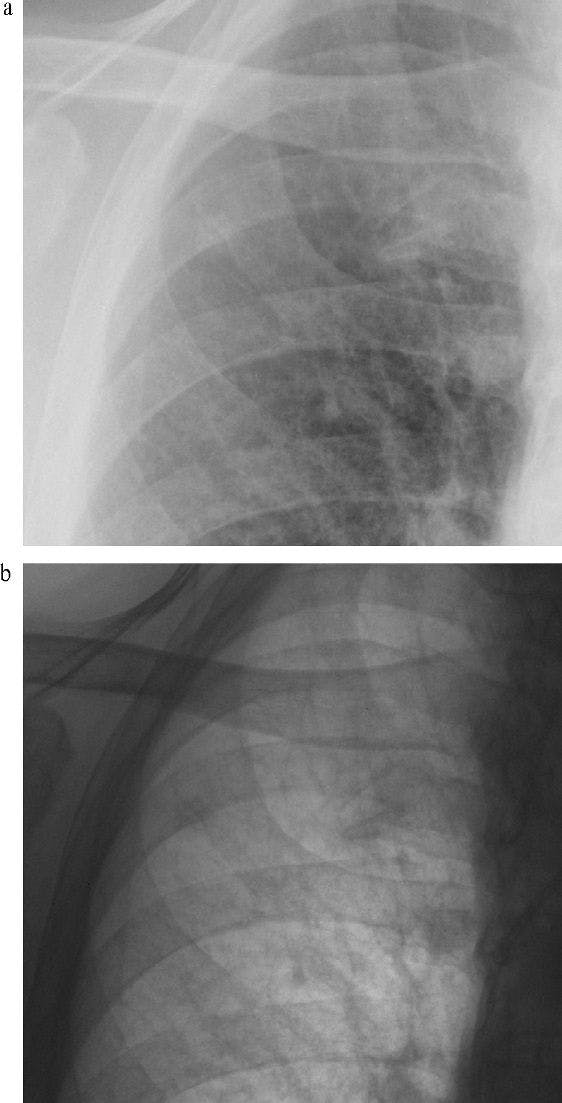 Viewing Radiographs as ‘Bones Black’ Helped Detect Lung Nodules
