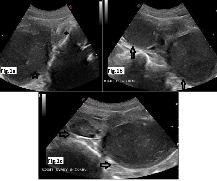Obstructed Hemivagina and Ipsilateral Renal Agenesis (OHVIRA)