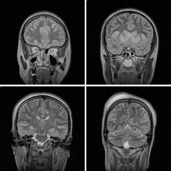 MRI Findings in Attempted Hanging