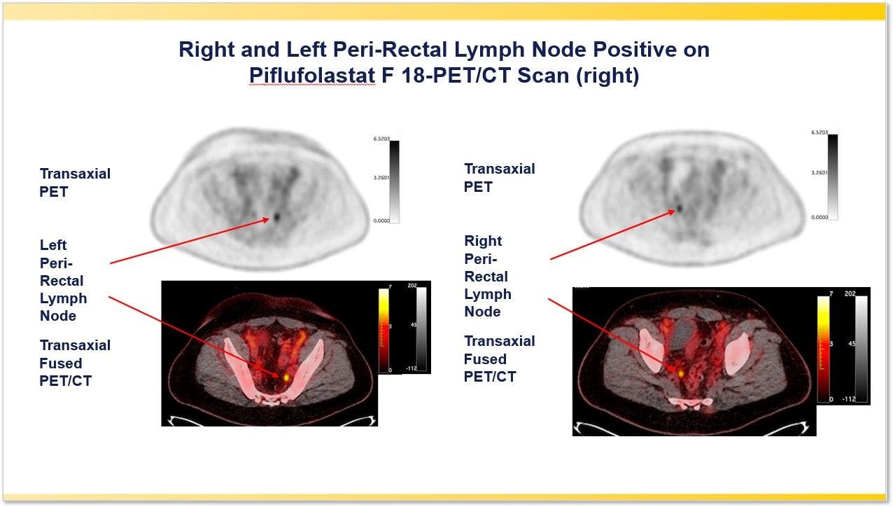 Case example: A 54-year-old man with a history of RP+LND and a subsequent PSA of 1.25 ng/mL had no evidence of disease by baseline imaging. Piflufolastat F 18 (18F-DCFPyL)- PET/CT accurately detected biochemically recurrent prostate cancer with the PSMA PET/CT scan identifying positive left (left panel) and right peri-rectal lymph nodes (right panel).

Credit: Steven Rowe, M.D., Ph.D., Johns Hopkins University