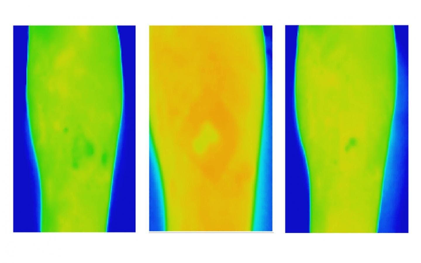 Thermal images of a venous leg ulcer showing healthy healing progress over three weeks.

CREDIT: RMIT University