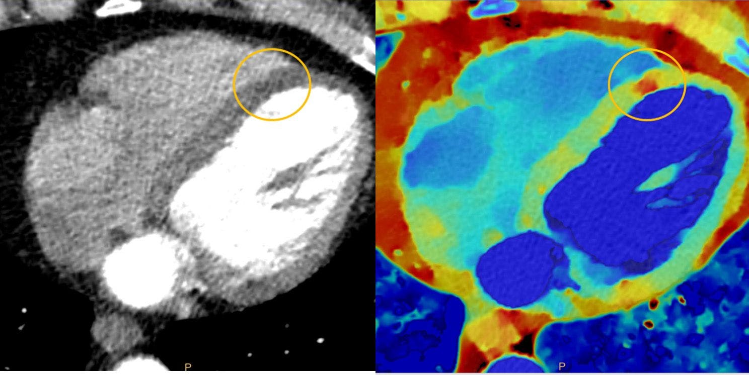 Beam-hardening artificacts can make myocardial perfusion defects difficult to detect on conventional CT. Spectral CT reduces those artifacts, allowing for easier visualitzation and quantification of perfusion defect.

Credit: Philips Healthcare