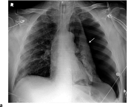 X-ray Identifies More Air Pressure Lung Injuries in COVID-19 Patients