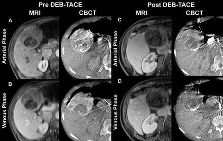 Specialized CT Scans Detect Chemo Death of Liver Tumors