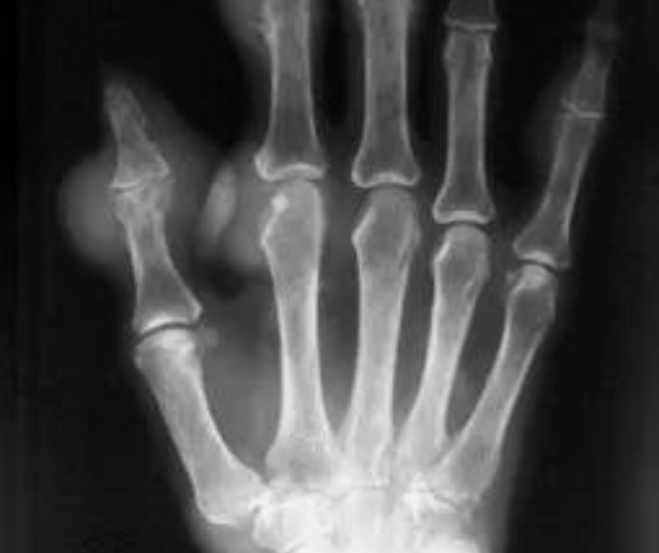 Image iQ Quiz: 35-Year-Old Man with a High-Protein Diet and Chronic Hand Pain