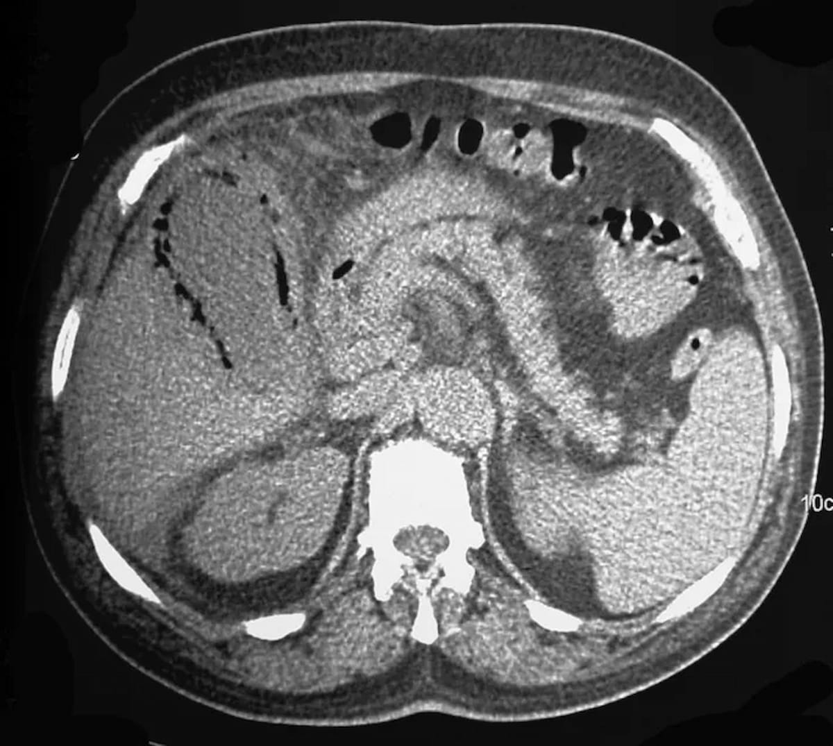 Image IQ Quiz: Patient with Diabetes, Upper Quadrant Pain and Signs of Sepsis