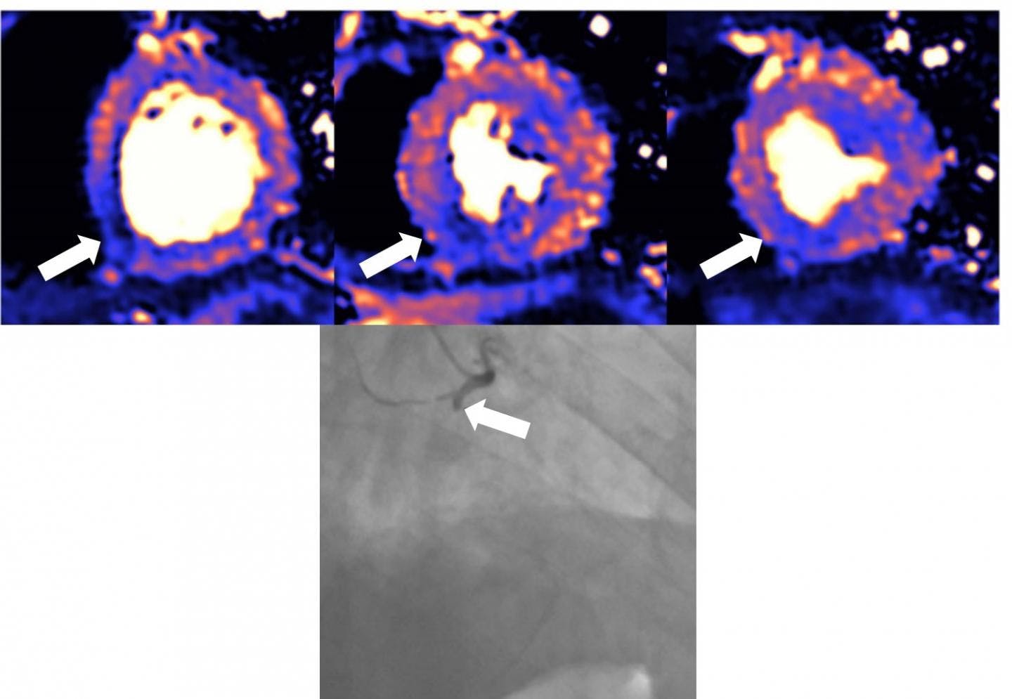 MRI scan of damaged heart. Blue means reduced blood flow, orange is good blood flow. In this figure the inferior part of the heart shows dark blue, so the myocardial blood flow is very reduced and the black and white angiography, which looks directly at the blood vessels, shows that the vessel which supplies the blood to this part of the heart is occluded. The 3 colored images are 3 different slices of the heart: the basal the mid and the apical slice.

CREDIT

European Heart Journal