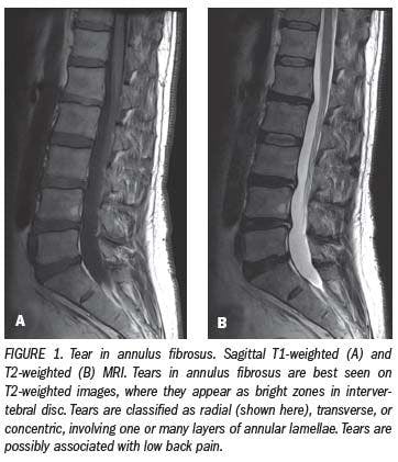 Correct Application Of MRI: helps find causes of lower back pain