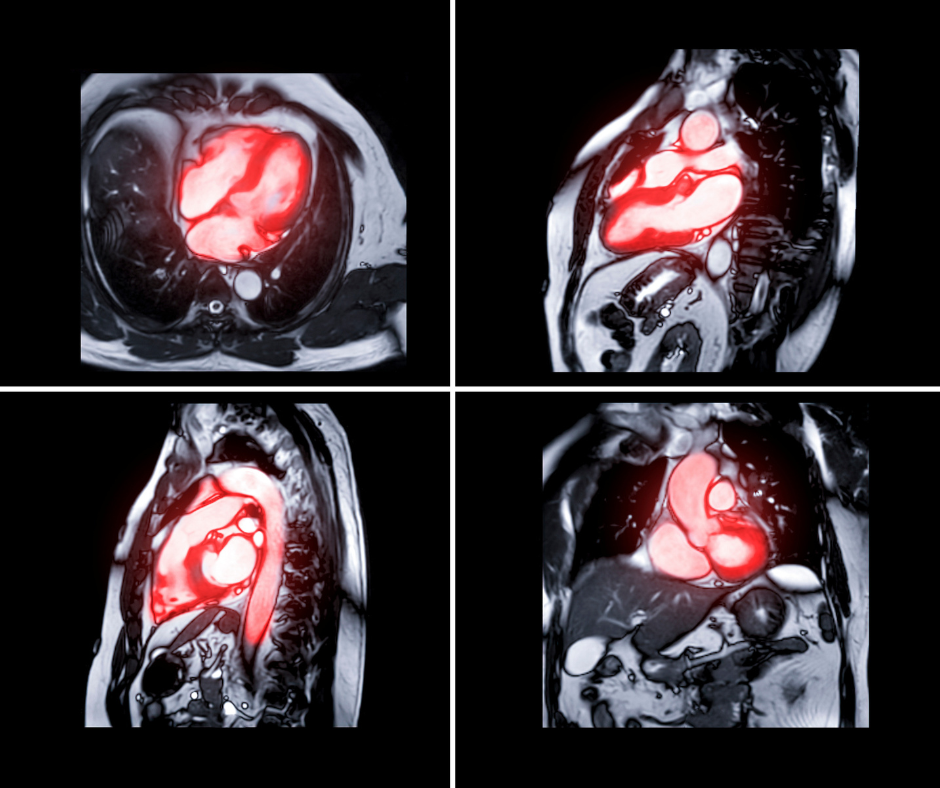 What a New Study Reveals About MRI Use and Implantable Cardioverter Defibrillators