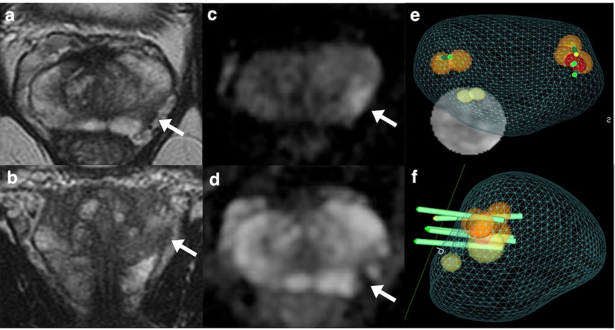 Study: Abbreviated Non-Contrast MRI May Facilitate Early Detection of Prostate Cancer