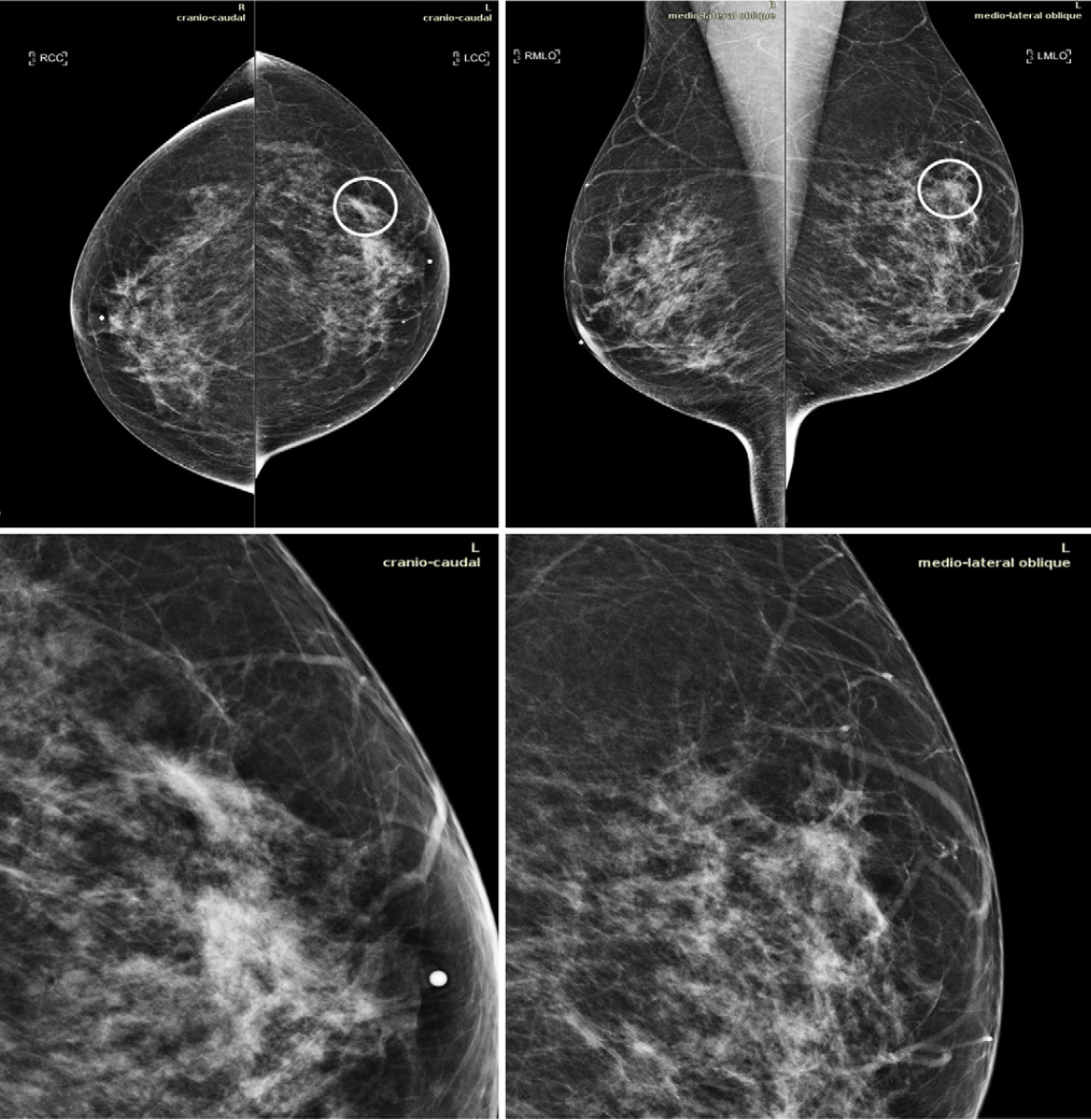 Mammography AI Tool Cleared This Year Improves Breast Cancer Detection