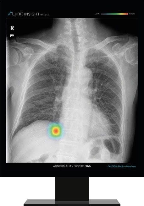 Lunit INSIGHT CXR detects findings and provides abnormality score on a chest X-ray image

Credit: Lunit