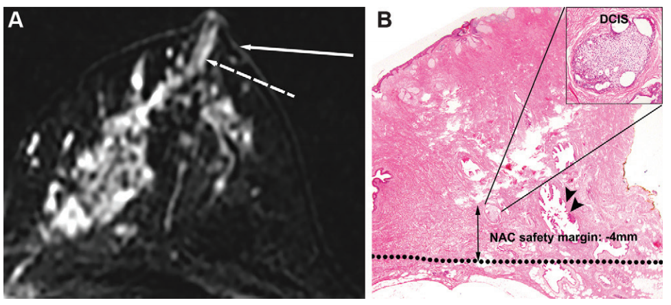 Images in a 49-year-old woman in the nonmass enhancement (NME) extension group with pathologic nipple invasion. (A) Contrast-enhanced fat-suppressed T1-weighted axial MRI scan obtained in first postcontrast phase shows that linear NME (dashed arrow) extends to the nipple base (solid arrow). (B) Photomicrograph (hematoxylin-eosin stain; original magnification, 35) shows nipple invasion. The lactiferous duct (arrowheads) is observed in the nippleareolar complex (NAC). The ductal carcinoma in situ (DCIS) involves the lactiferous duct beyond the baseline (dotted line). Inset is high-power view (original magnification, 3100) of the ductal carcinoma in situ.

Credit: RSNA