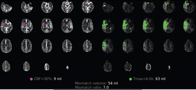 CT Study Examines Post-Reperfusion Infarction Growth in Vaccine-Naïve Patients with COVID-19