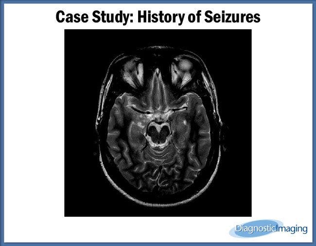 History of Seizures