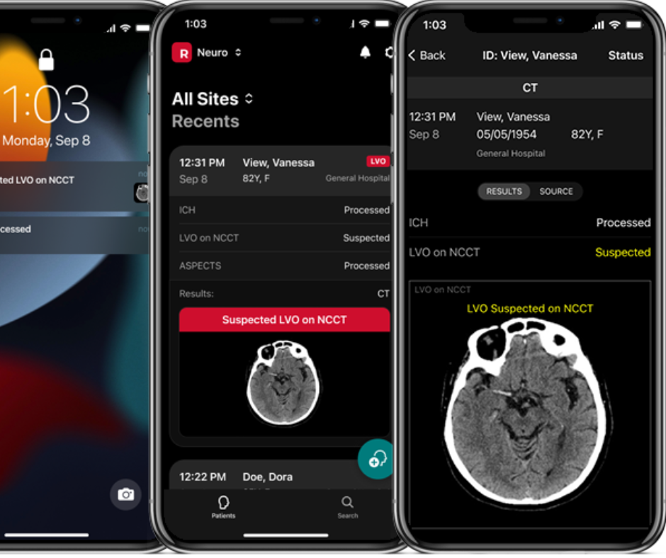 RapidAI Gets FDA Nod for AI Assessment of Non-Contrast CT for Acute Stroke Triage