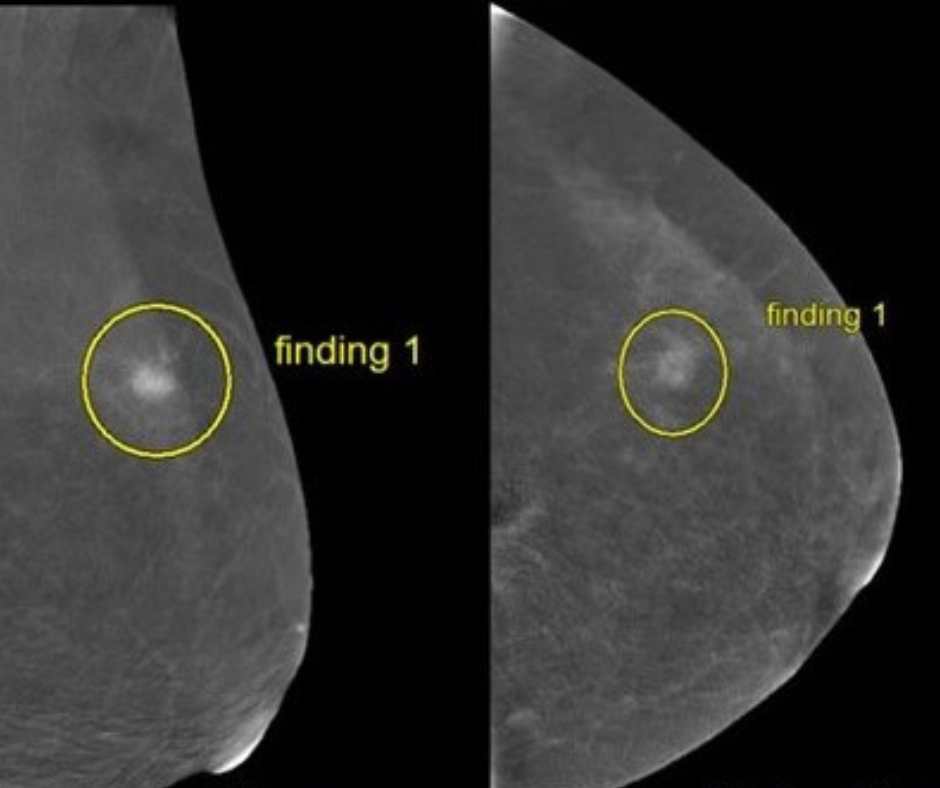 Does Timing of Imaging Affect Interpretation of Contrast-Enhanced Mammography?