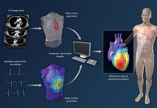 New ECG/CT Technique Pinpoints Cause of Abnormal Heartbeat