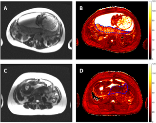 Can Placental MRI Help Identify Elevated Risks for Adverse Pregnancy Outcomes?