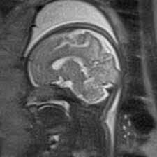 MRI for Better Fetal Abnormality Detection