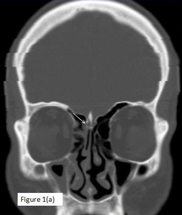 Cerebrospinal Fluid Fistula in Case of CSF Rhinorrhoea