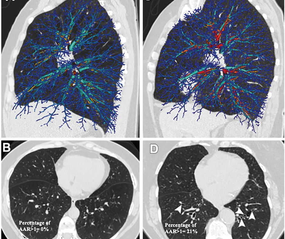 Study Says AI Can Enhance Chest CT Assessment of Bronchiectasis in Ever-Smokers