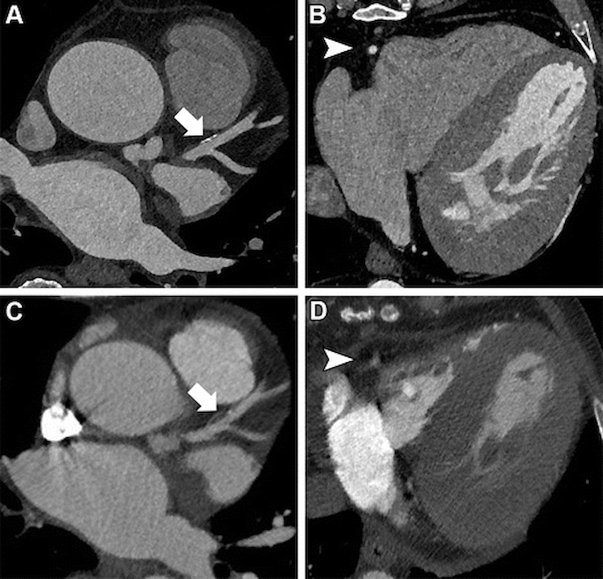 Study Examines Photon-Counting CT for Detection of CAD in Patients Having TAVR Procedures