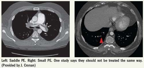 Radiologists question whether to treat small pulmonary emboli