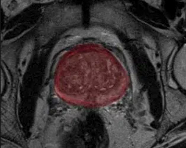 Can a New AI Tool Have an Impact in MRI Screening for Prostate Cancer?