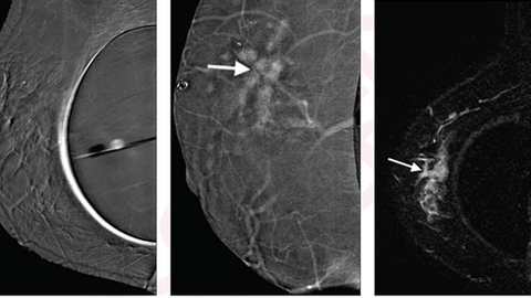 Contrast-Enhanced Mammography Equivalent to MRI for Breast Cancer Detection in Women with Implants