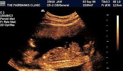 SAG Fetal Body Gastroschisis