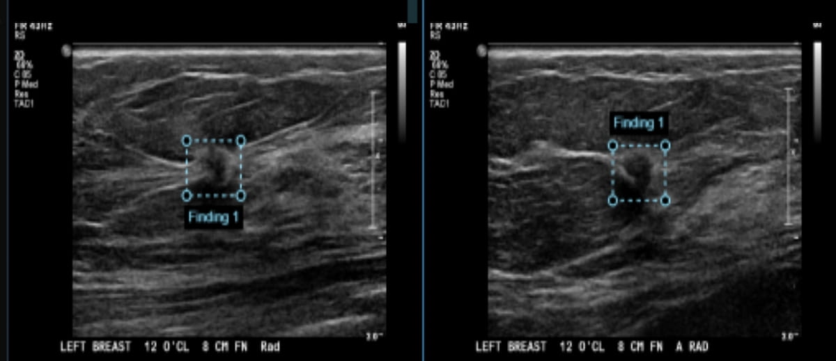 New Study Shows Viability of Adjunctive AI for Breast Ultrasound
