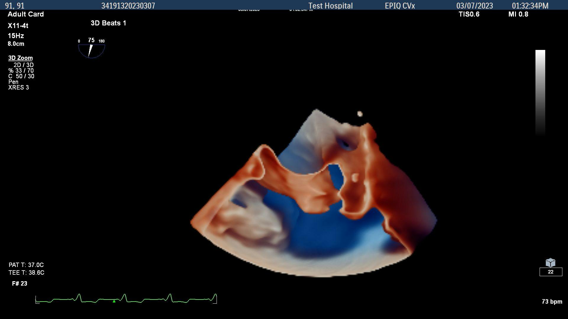 FDA Clears Mini Transesophageal Echocardiography Ultrasound Transducer