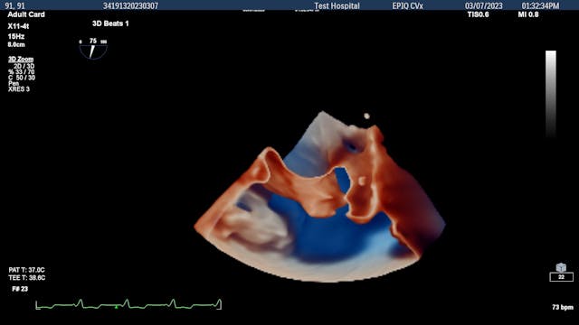 FDA Clears Mini Transesophageal Echocardiography Ultrasound Transducer