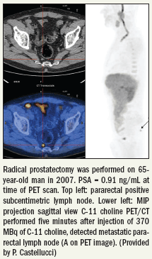 C-11 Cho PET/CT helps localize prostate cancer recurrence