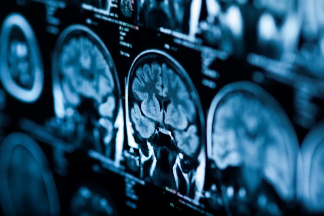 FDA Clears AI-Powered Brain Volumetry Software for MRI 