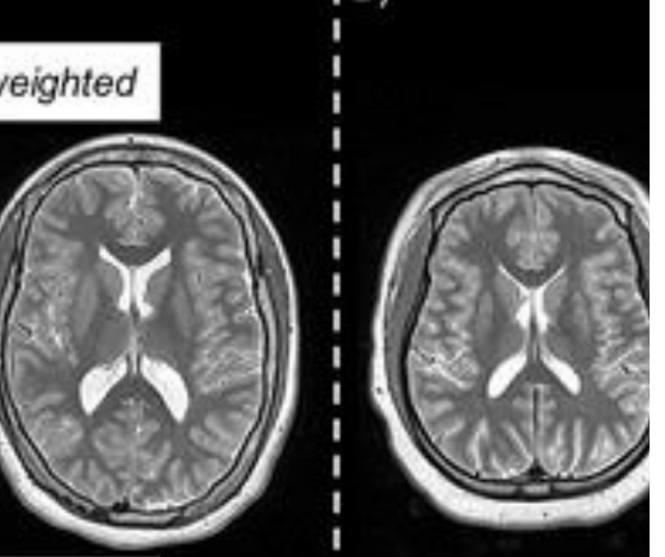 Study Says Quantitative MRI Can Detect Biomarkers of Neurological Conditions in Adolescents with Extremely Preterm Birth
