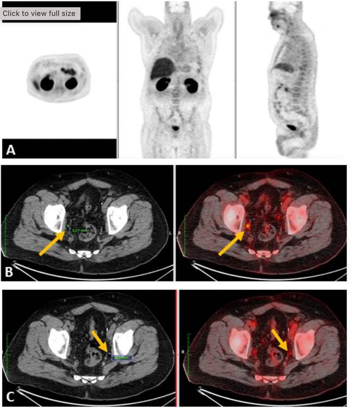 Emerging PET Radiotracer May Offer Multiple Advantages in Detecting Prostate Cancer